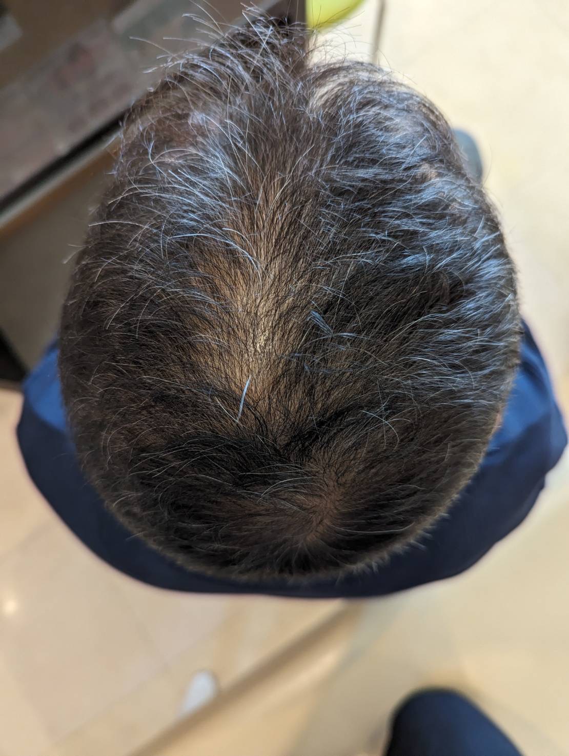 薄毛施術4ヶ月後