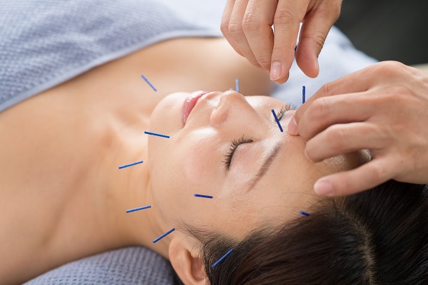 3. 美容鍼・プチ美の施術風景